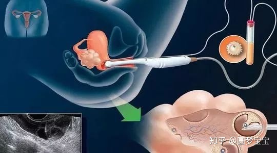 黄石大陆首个借卵试管婴儿，再过5天就30岁了......但借卵试管婴儿之母并没有等到这一天