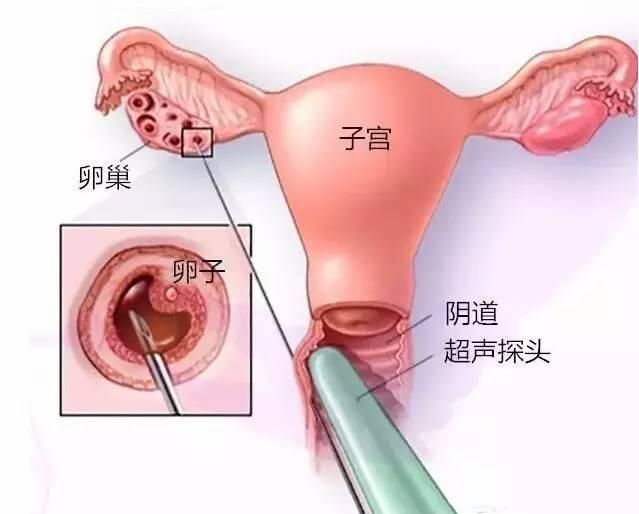 渭南捐献者_借卵做试管三代代怀要打多少针？排卵针是怎么打的？