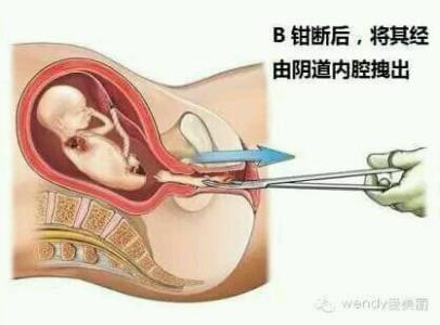 腹腔镜子宫肌瘤手术后多久才能人工供卵试管